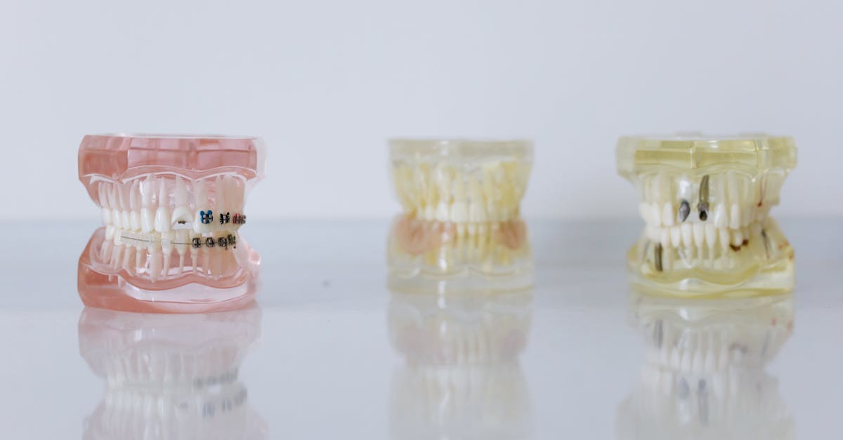 Frequency Guidelines for Check-ups After Dental Implant Surgery