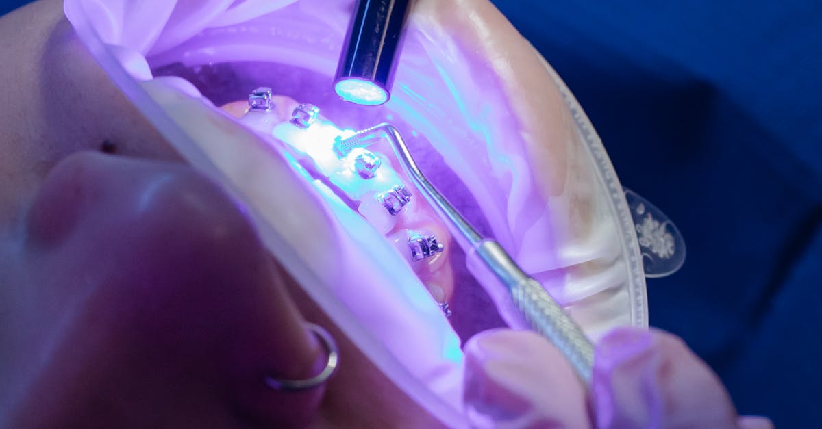 How to Choose the Right Toothpaste for Dental Implants