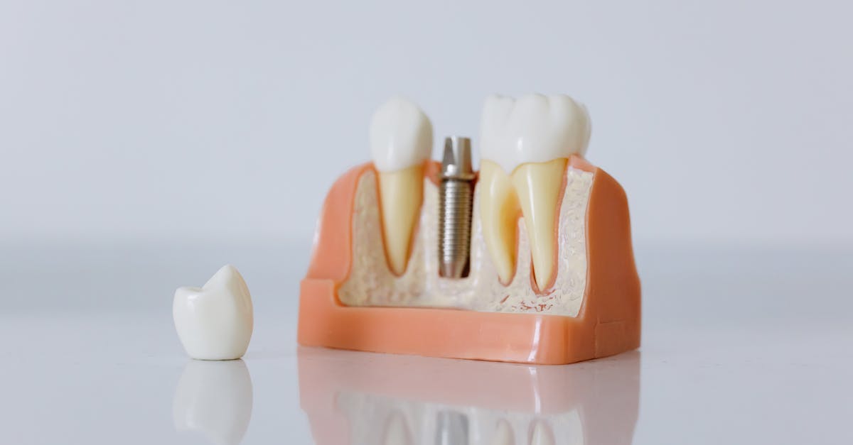 Mini Dental Implants: A Solution for Tooth Gaps
