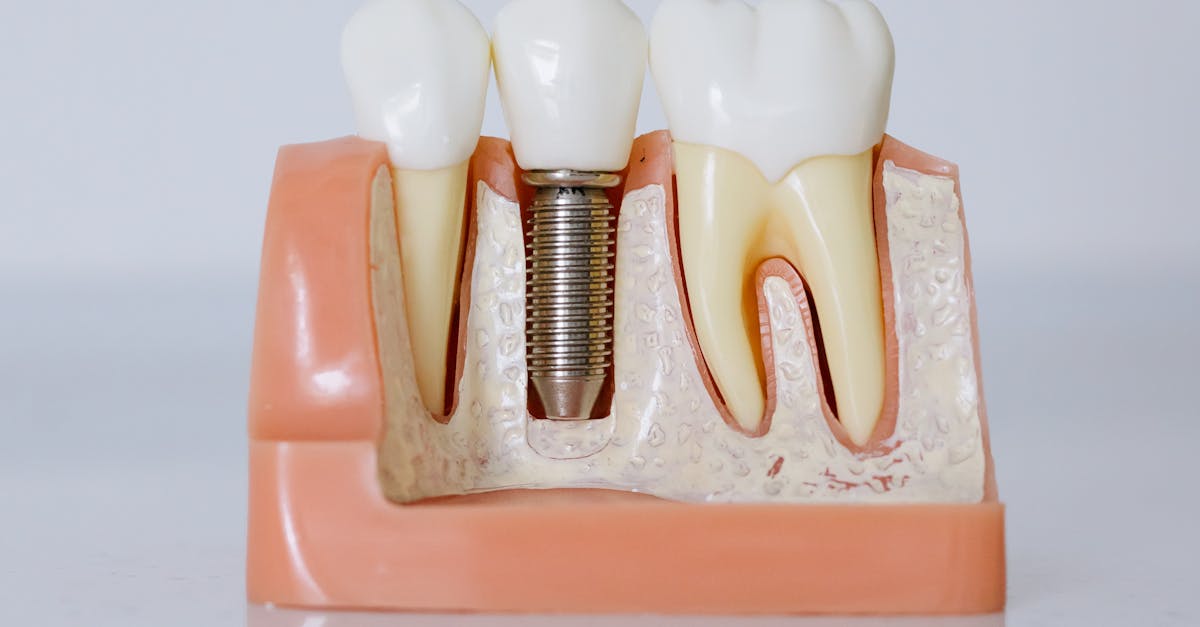 Risks and Complications Associated with Immediate Loading