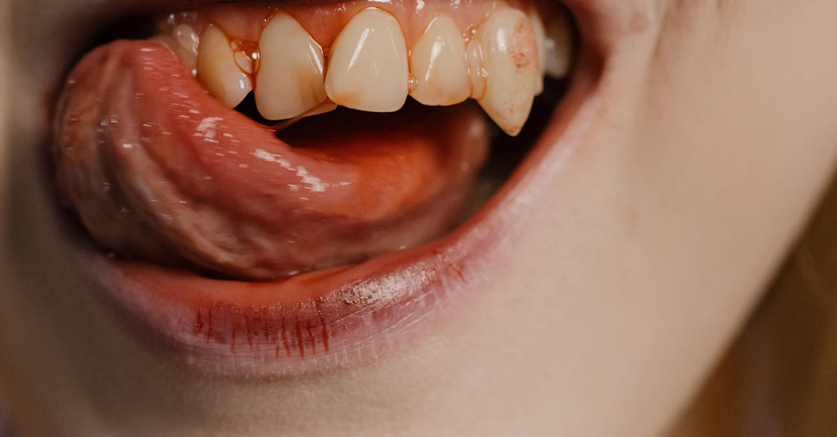 What to Expect During the First Week of Dental Implant Recovery